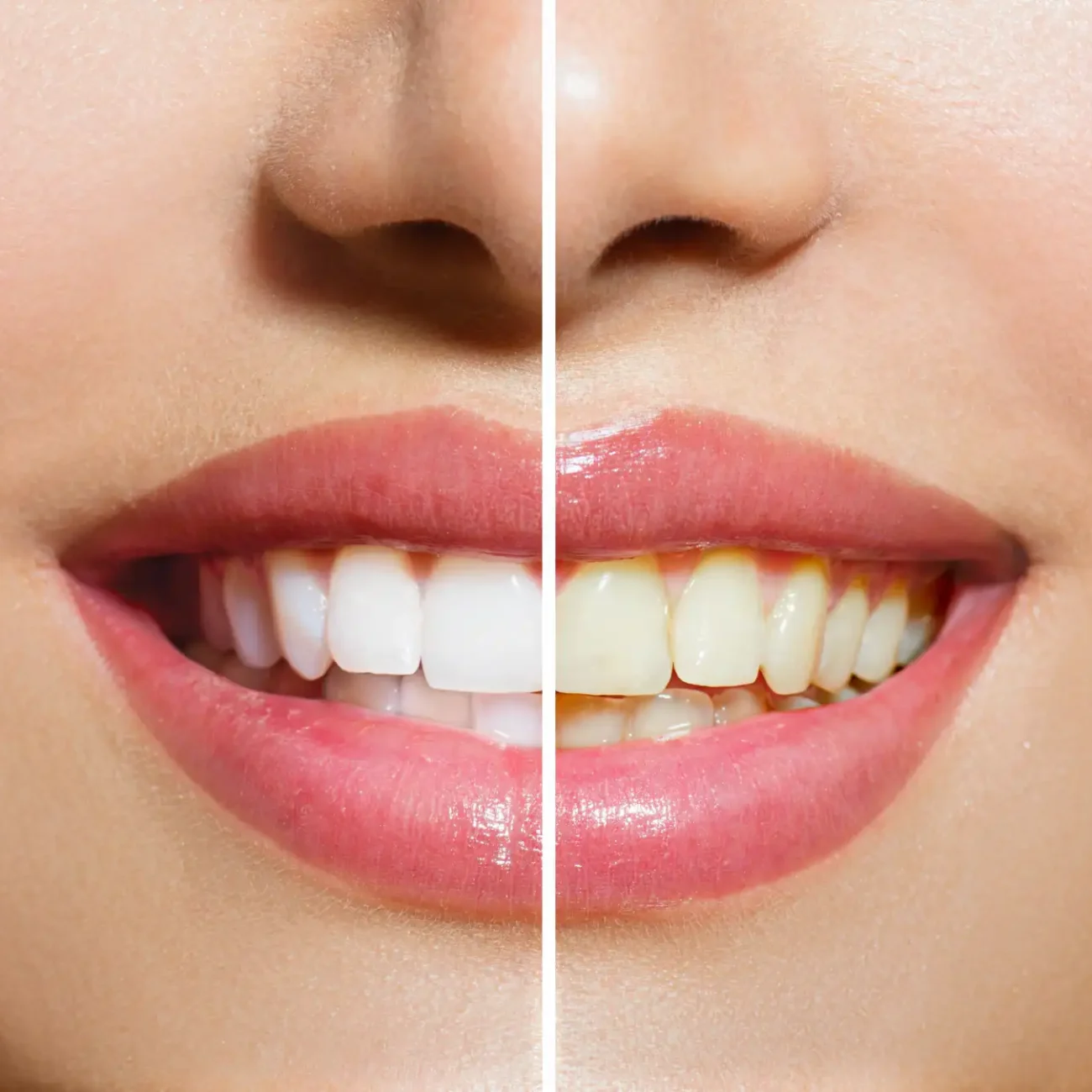 Teeth Whitening treatment